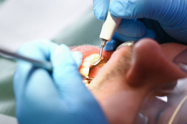 Best Emergency Dental Care for Abscessed Tooth in Graton, CA